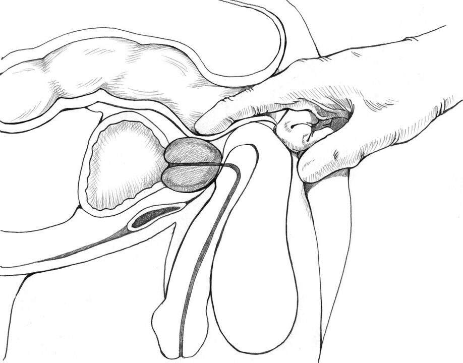 Masáž prostaty je súčasťou komplexu metód liečby prostatitídy