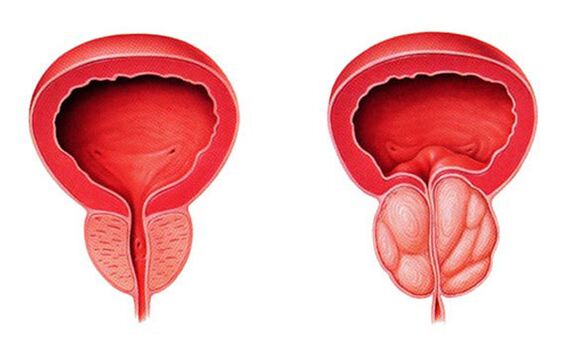 Normálna a zapálená prostata (prostatitída)